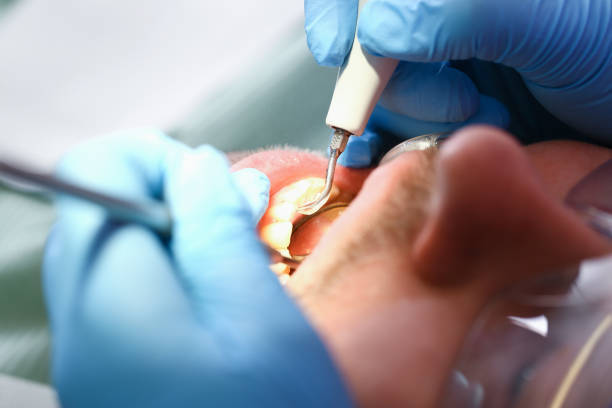 Best Teeth Whitening  in Springfield, SD